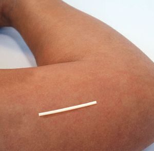Implant